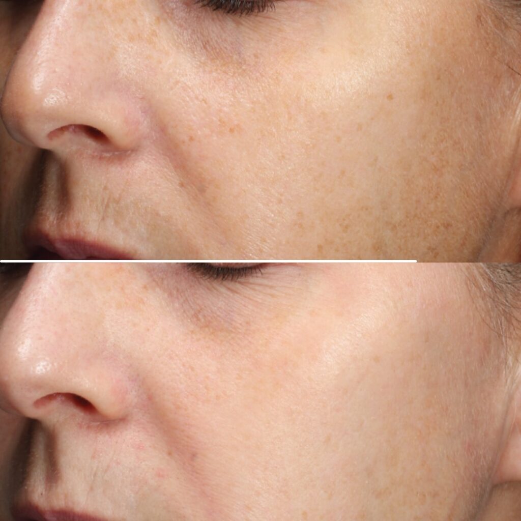 Niacinamide